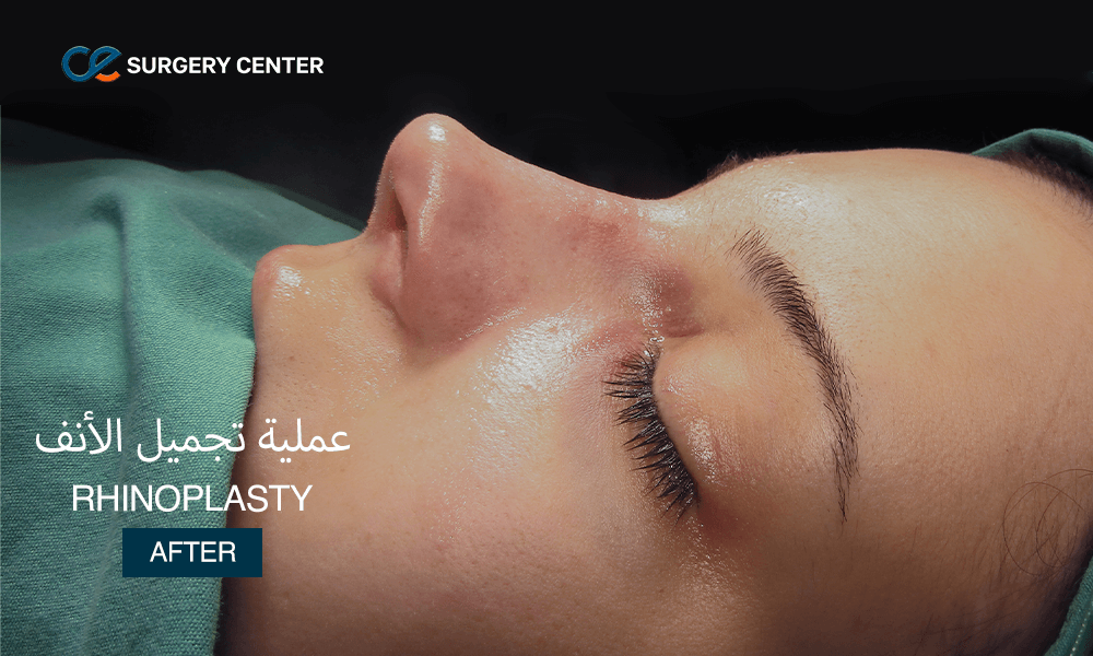 تجميل الأنف في تركيا