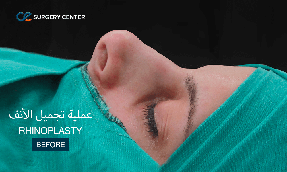 تجميل الأنف في تركيا