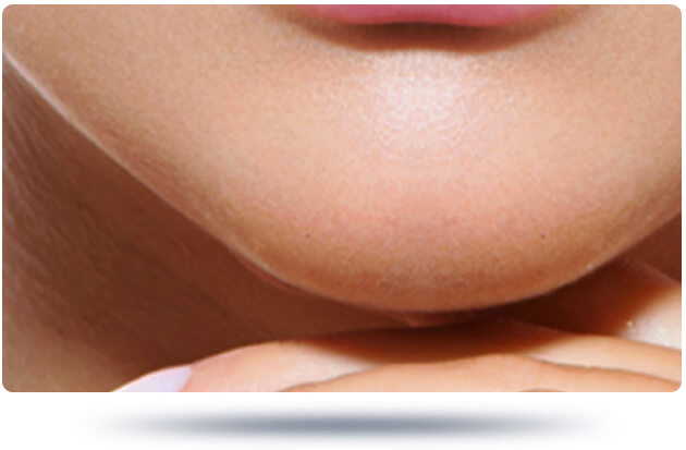 تجميل الذقن