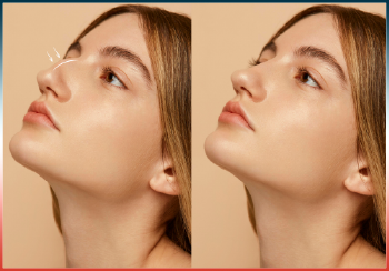 Rhinoplasty Preservation
